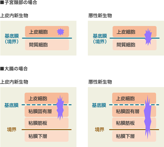 上皮内新生物と悪性新生物の違い
